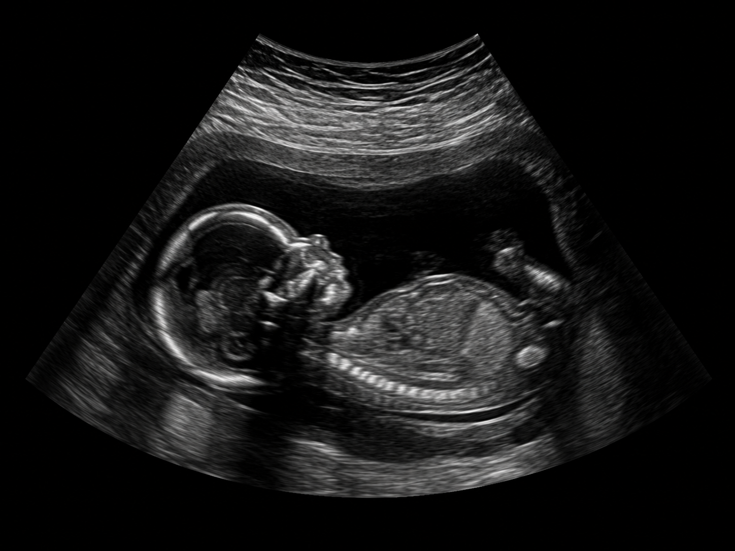 2D Ultrasound scan