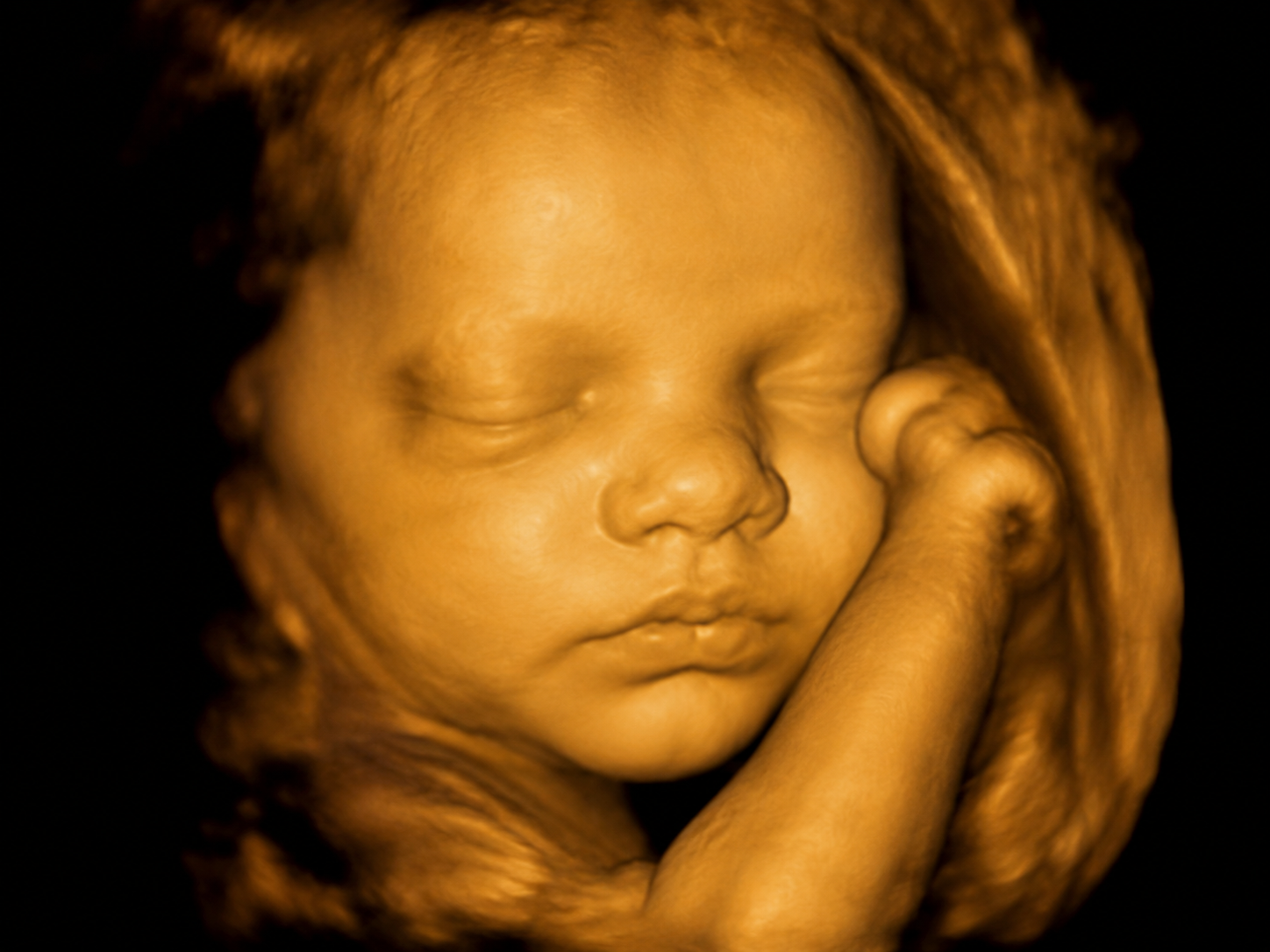 3D Ultrasound scan